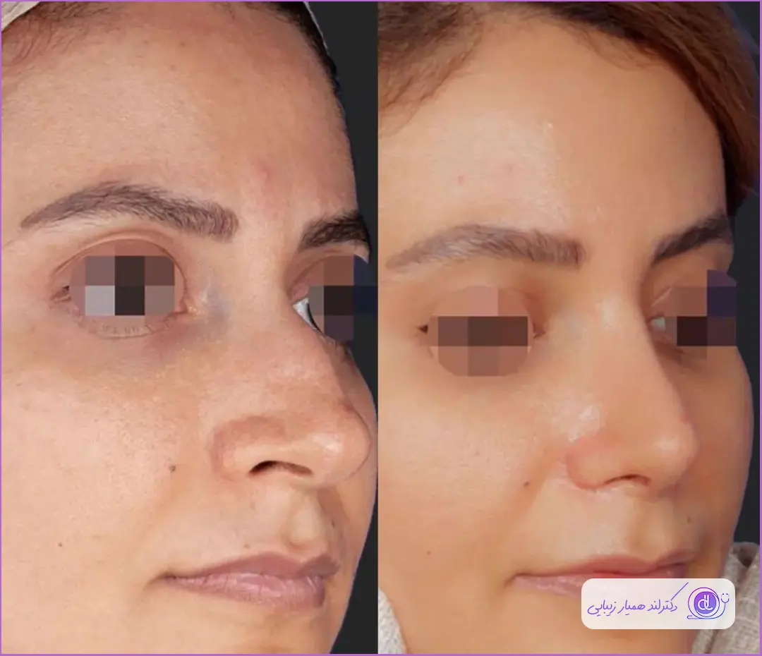 نمونه قبل و بعد عمل بینی گوشتی زنانه دکتر محسن روشنی