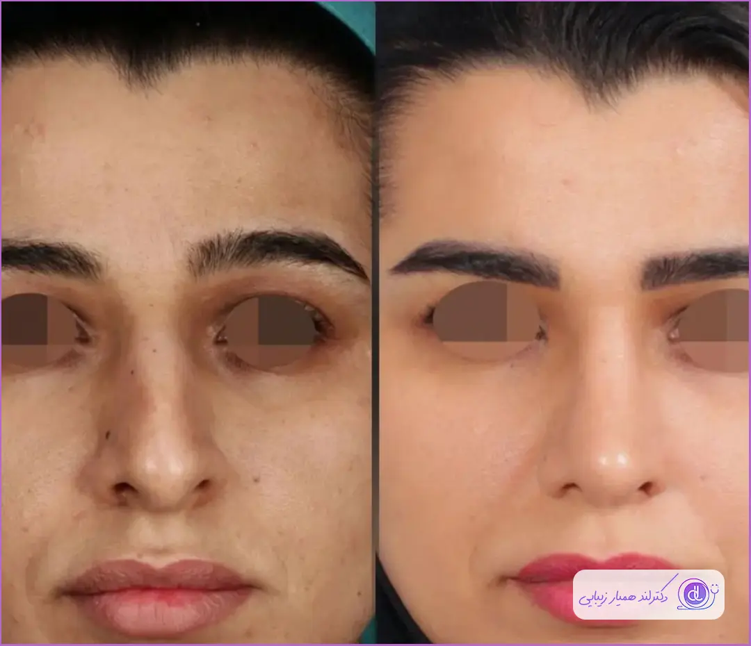 نمونه قبل و بعد عمل جراحی بینی استخوانی زنانه در مشهد