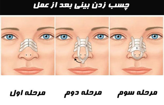 چسب زدن پس از جراحی بینی