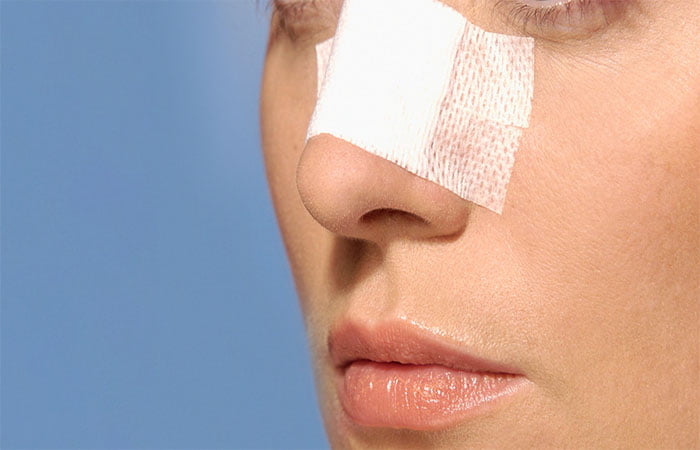 چسب زدن پس از جراحی بینی