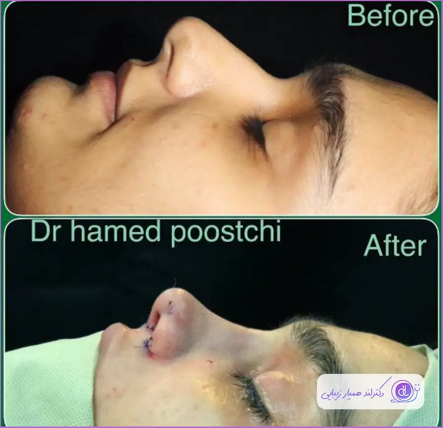 قبل و بعد عمل بینی گوشتی به روش باز دکتر حامد پوستچی