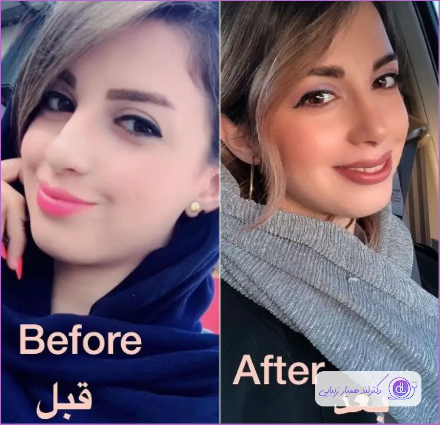 نمونه قبل و بعد جراحی زیبایی دماغ زنانه دکتر حامد پوستچی