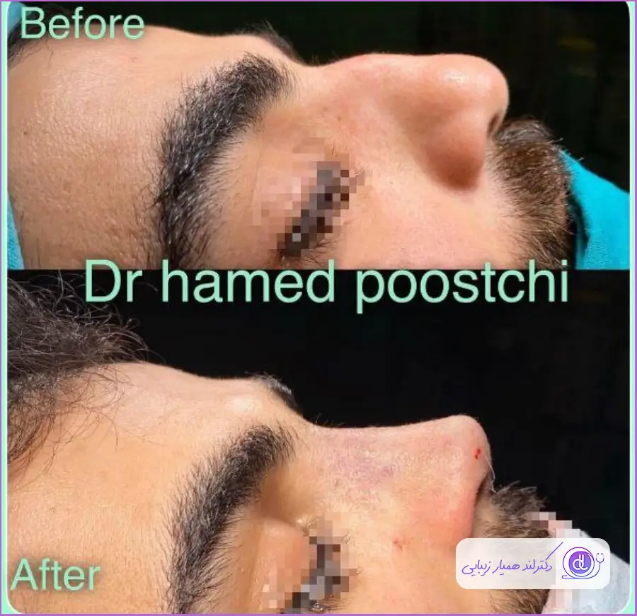قبل و بعد عمل زیبایی دماغ مردانه دکتر حامد پوستچی