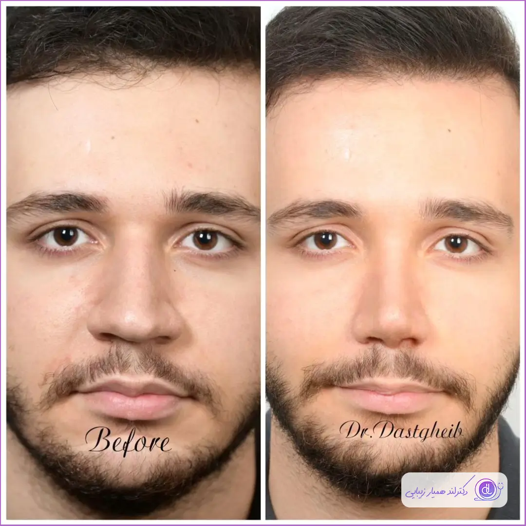 نمونه قبل و بعد جراحی بینی گوشتی مردانه دکتر سیدحسین دستغیب