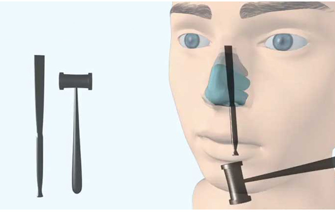 ابزار‌های جراحی بینی