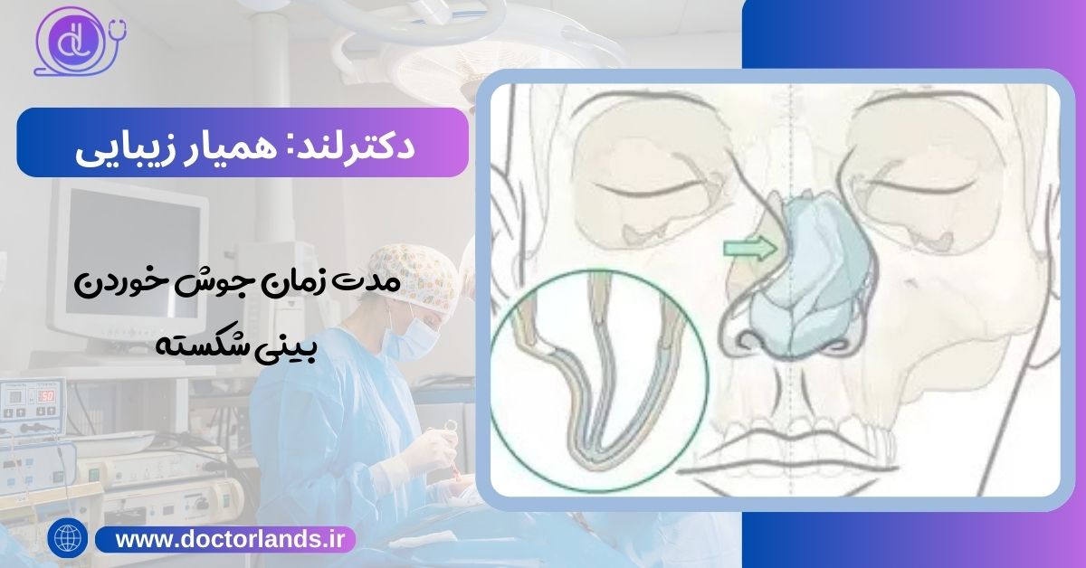 مدت زمان جوش خوردن بینی شکسته