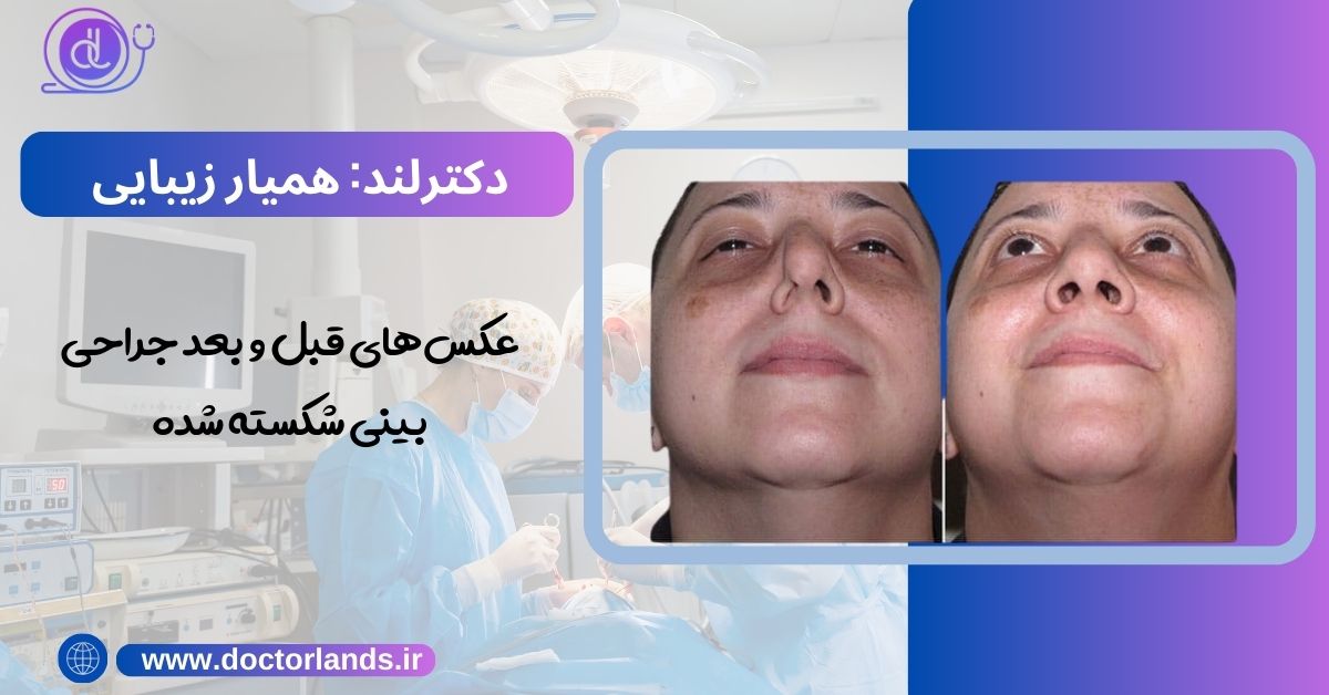 عکس‌های قبل و بعد جراحی بینی شکسته شده