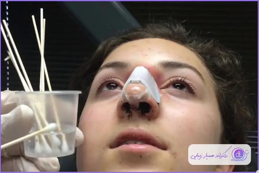 مراقبت های لازم برای بعد از جراحی زیبایی بینی در ارومیه