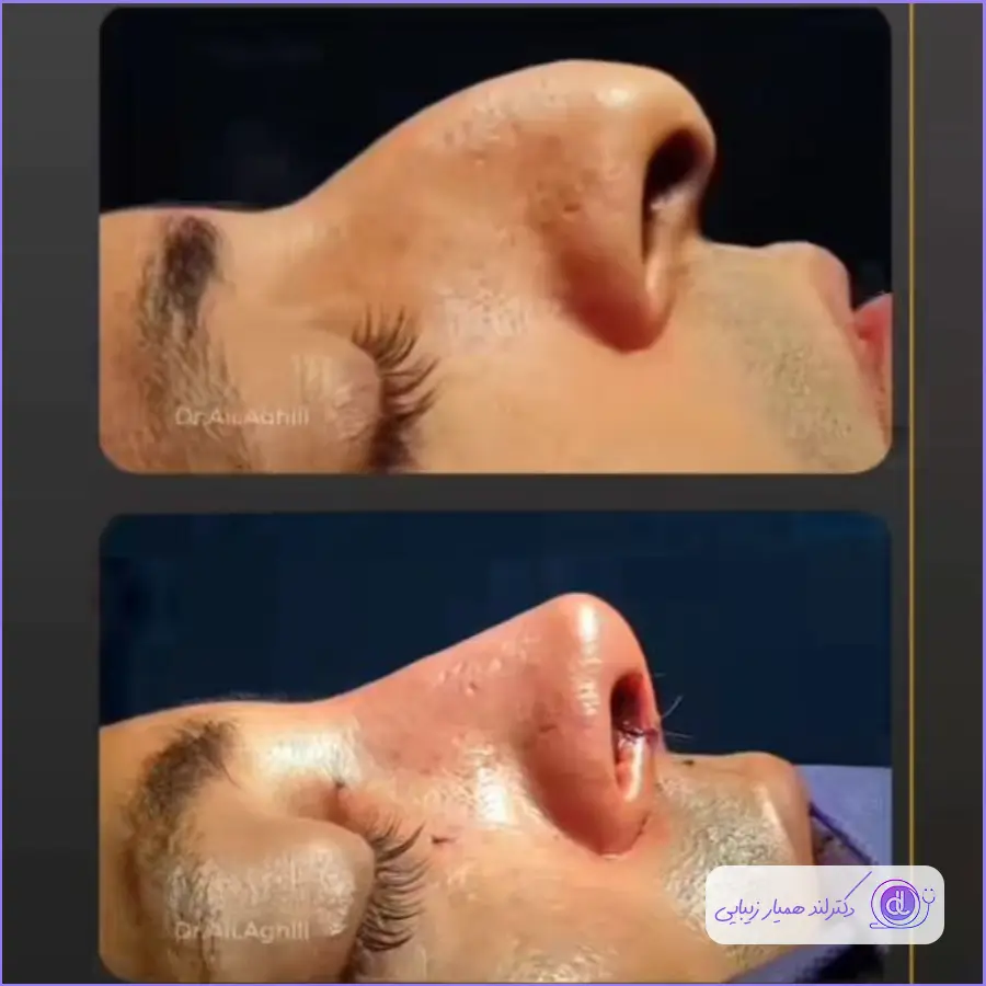 نمونه قبل و بعد جراحی بینی استخوانی مردانه سبک طبیعی دکتر علی عقیلی