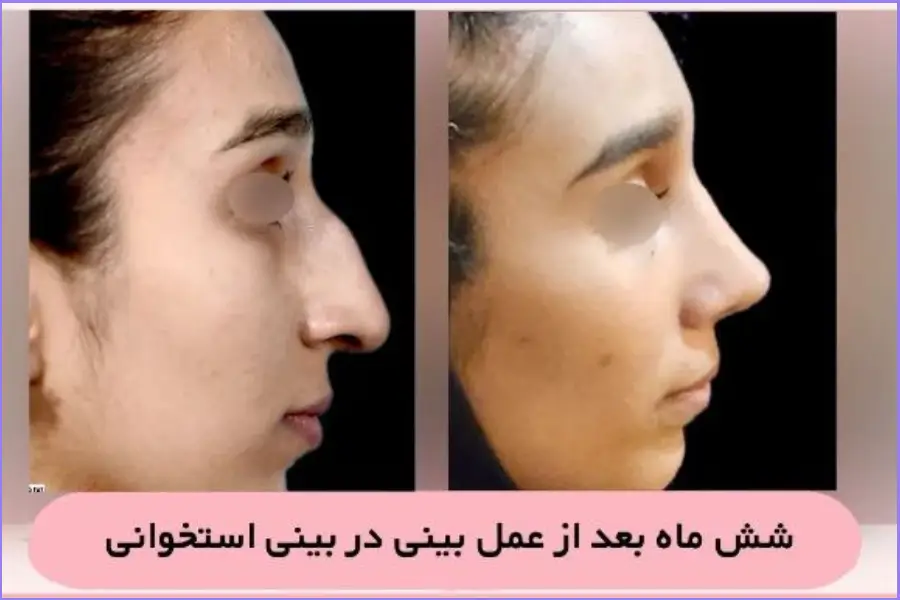 نمونه کار قبل و بعد رینو پلاستی بینی استخوانی دکتر علی اصغر نریمانی
