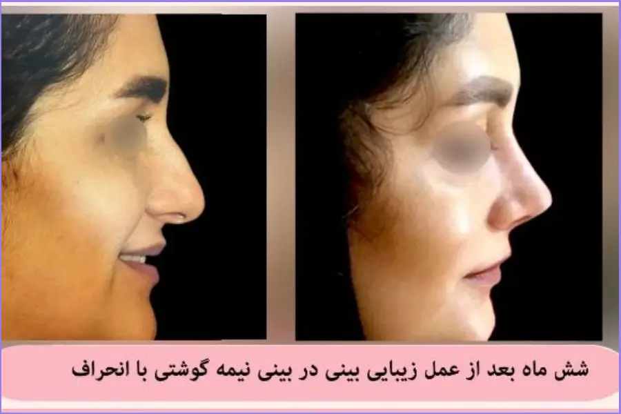 قبل و بعد جراحی بینی با انحراف به سبک نیمه فانتزی دکتر علی اصغر نریمانی در شیراز