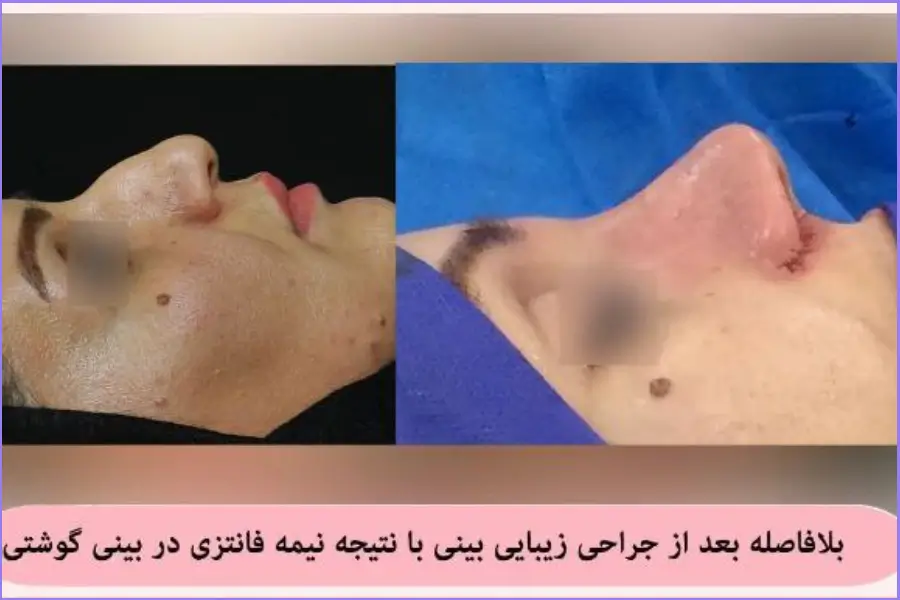 نمونه عمل جراحی دماغ گوشتی دکتر علی اصغر نریمانی