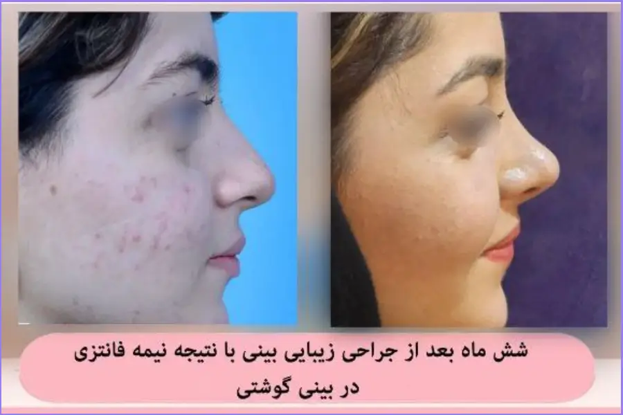 عمل زیبایی بینی زنانه طبیعی دکتر علی اصغر نریمانی