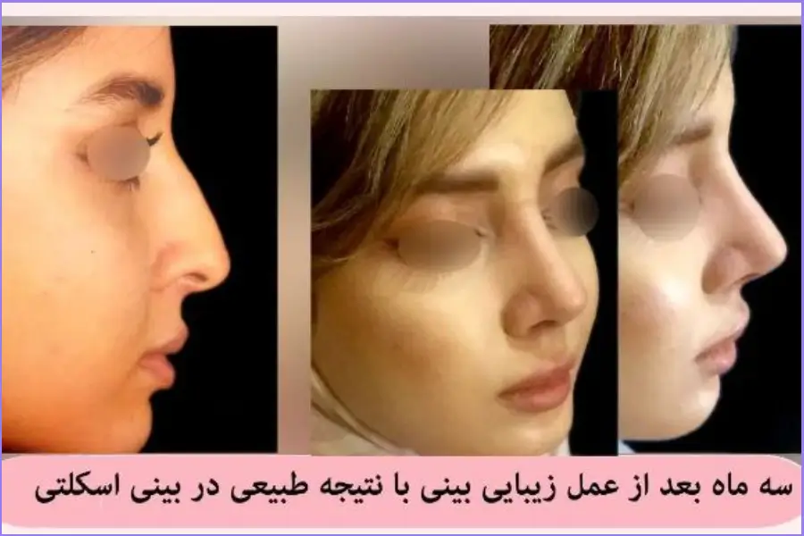 ۳ ماه بعد از عمل بینی استخوانی به سبک طبیعی در اصفهان