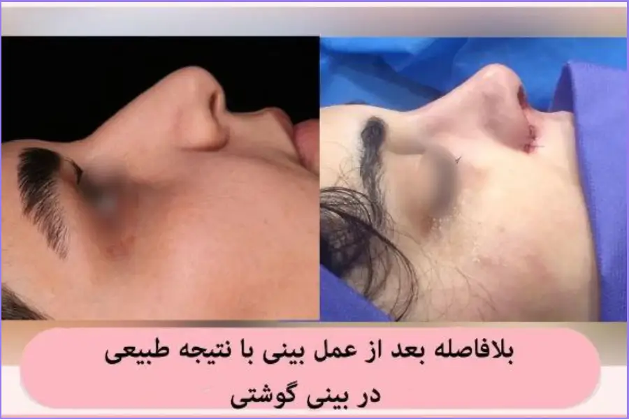 جراحی دماغ گوشتی خیلی بزرگ زنانه سبک طبیعی دکتر علی اصغر نریمانی