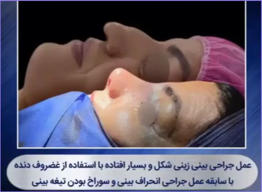 نمونه قبل و بعد عمل زیبایی بینی قوز دار استخوانی در اصفهان دکتر مهشید خورده چی