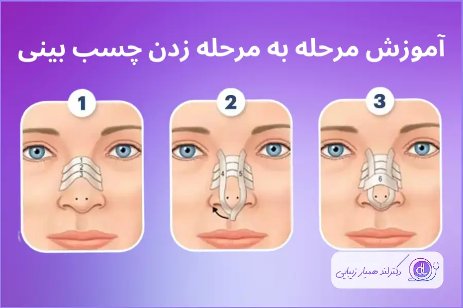 مراحل چسب زدن بینی گوشتی بعد از عمل زیبایی بینی