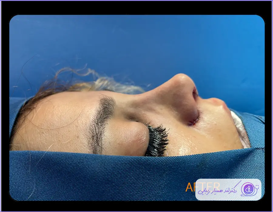 مدل عمل زیبایی بینی دکتر آرش سبحان منش