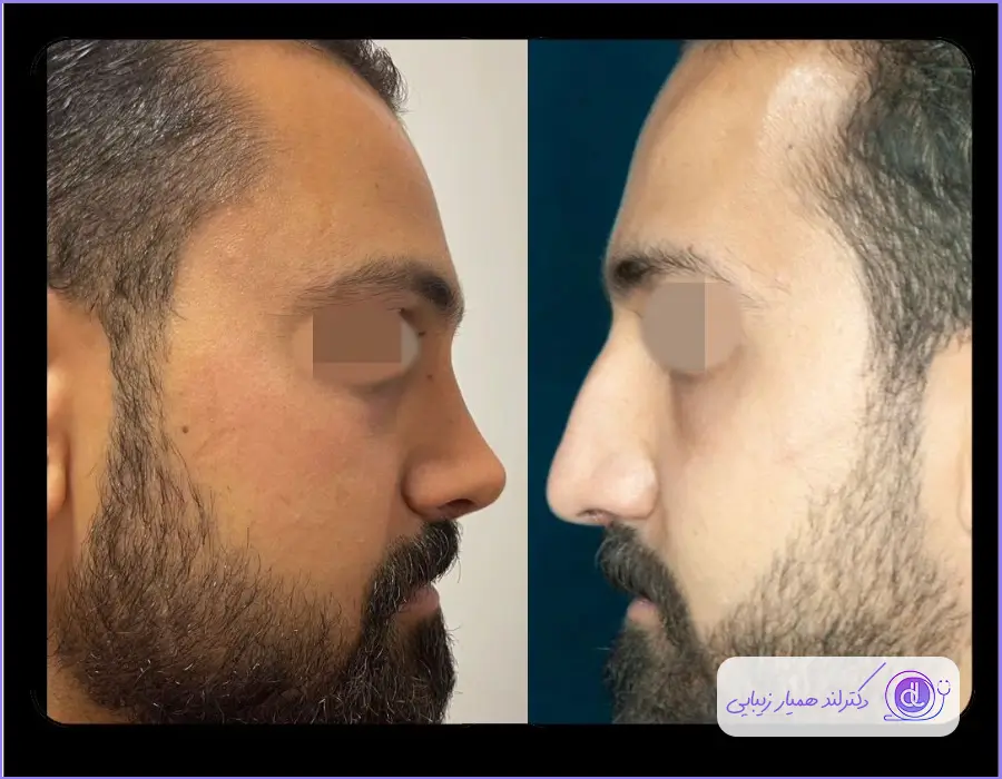 قبل و بعد عمل دماغ استخوانی مردانه دکتر آرش سبحان منش