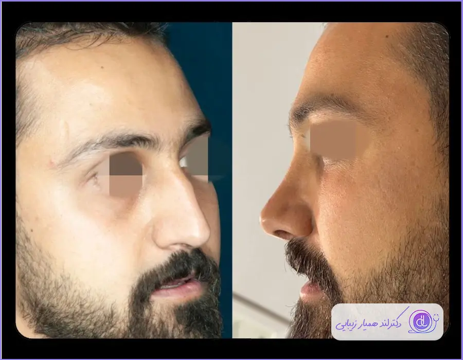 عکس قبل و بعد جراحی طبیعی بینی استخوانی مردانه دکتر آرش سبحان منش در شیراز