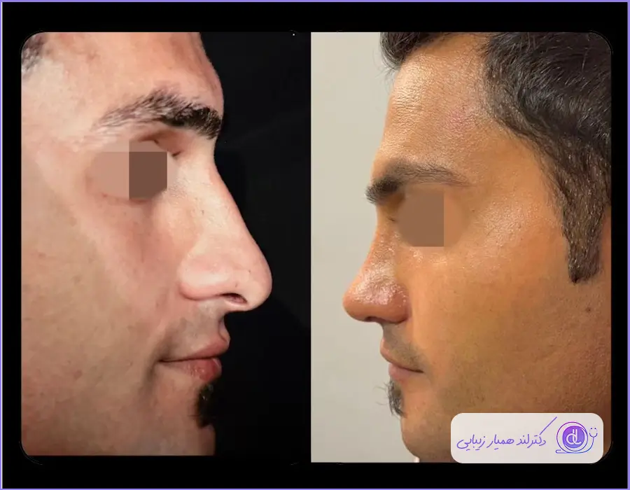  قبل و بعد عمل جراحی طبیعی بینی گوشتی مردانه دکتر آرش سبحان منش