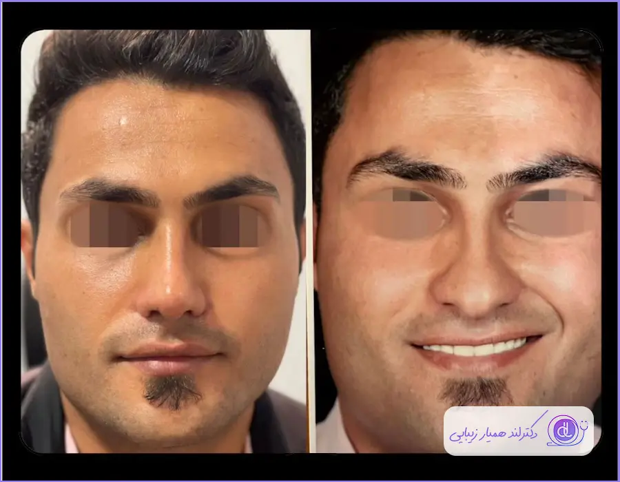 قبل و بعد جراحی بینی مردانه گوشتی خیلی بزرگ دکتر آرش سبحان منش