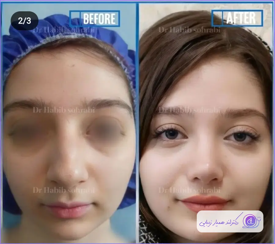 نمونه قبل و بعد عمل زیبایی بینی گوشتی دکتر حبیب سهرابی