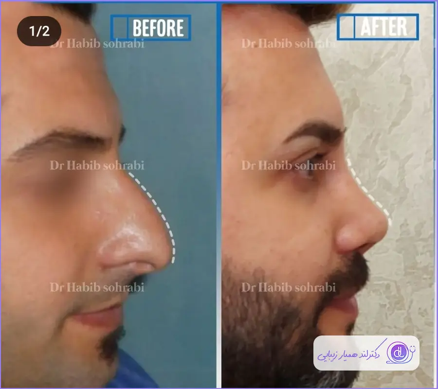 نمونه قبل و بعد جراحی دماغ گوشتی مردانه طبیعی دکتر حبیب سهرابی