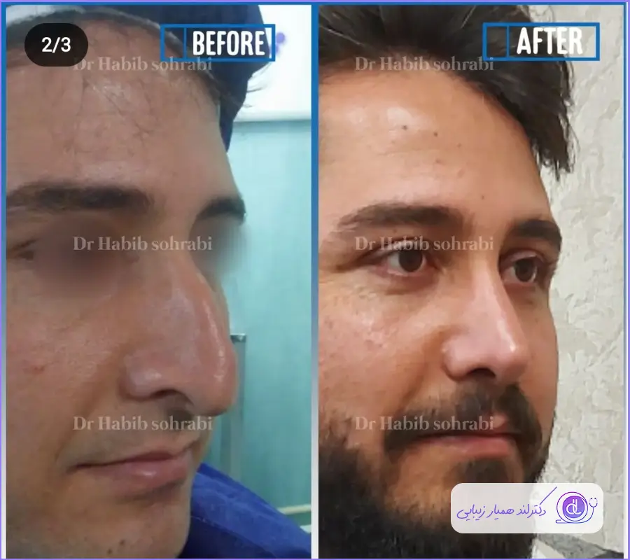 جراحی بینی مردانه استخوانی دکتر حبیب سهرابی