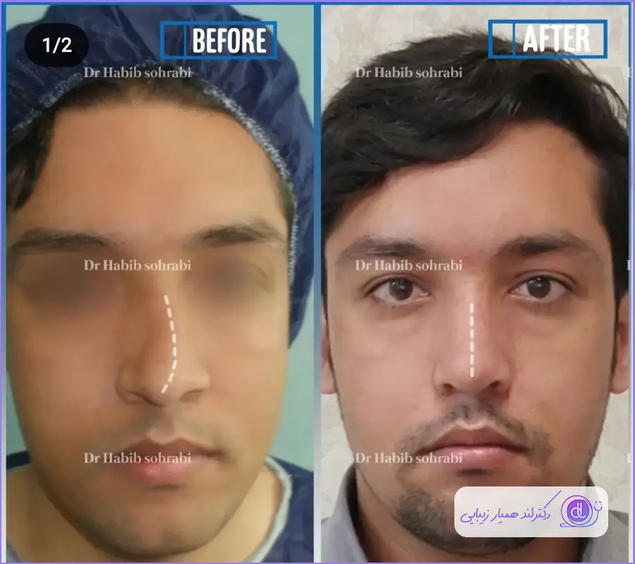 جراحی بینی کج مردانه به سبک طبیعی دکتر حبیب سهرابی