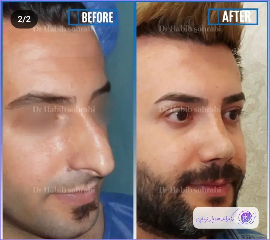 نمونه کار قبل و بعد جراحی بینی گوشتی طبیعی مردانه دکتر حبیب سهرابی