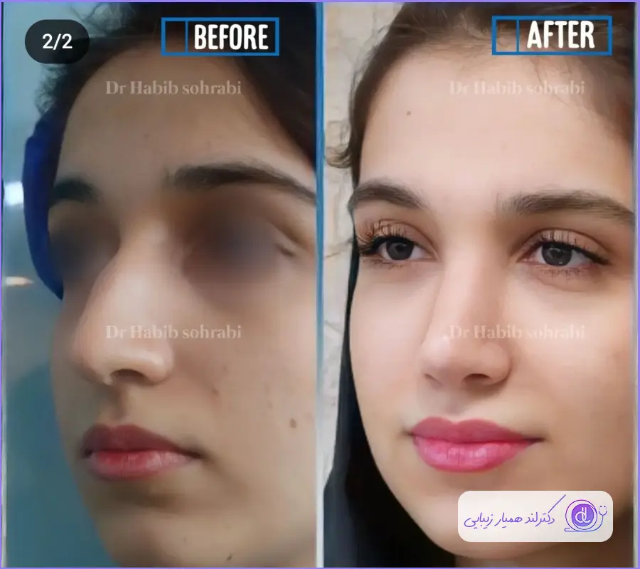 عکس قبل و بعد عمل بینی طبیعی زنانه دکتر حبیب سهرابی