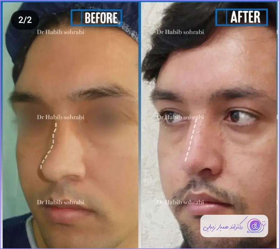 نمونه کار جراحی بینی استخوانی با سبک طبیعی مردانه دکتر حبیب سهرابی