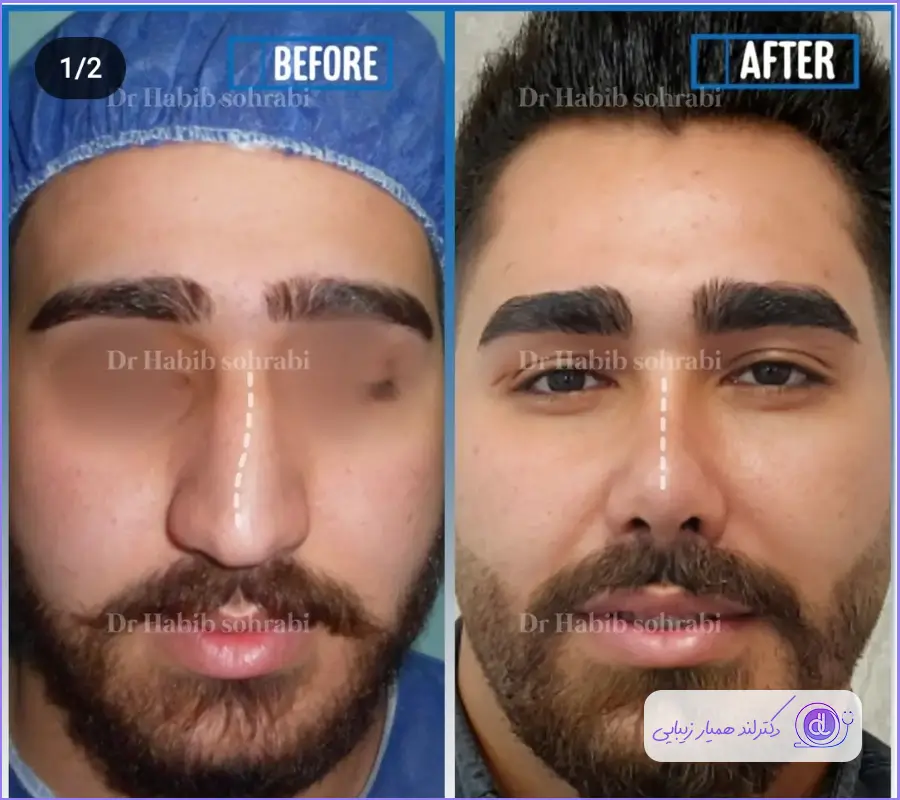 نمونه قبل و بعد عمل بینی طبیعی مردانه دکتر حبیب سهرابی