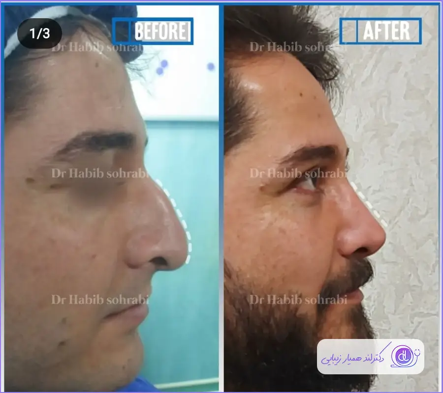 نمونه قبل و بعد عمل دماغ مردانه دکتر حبیب سهرابی