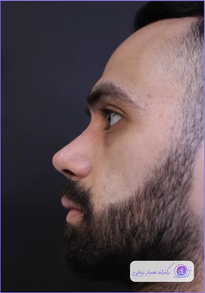 قبل و بعد جراحی بینی مردانه دکتر حمید نوری 
