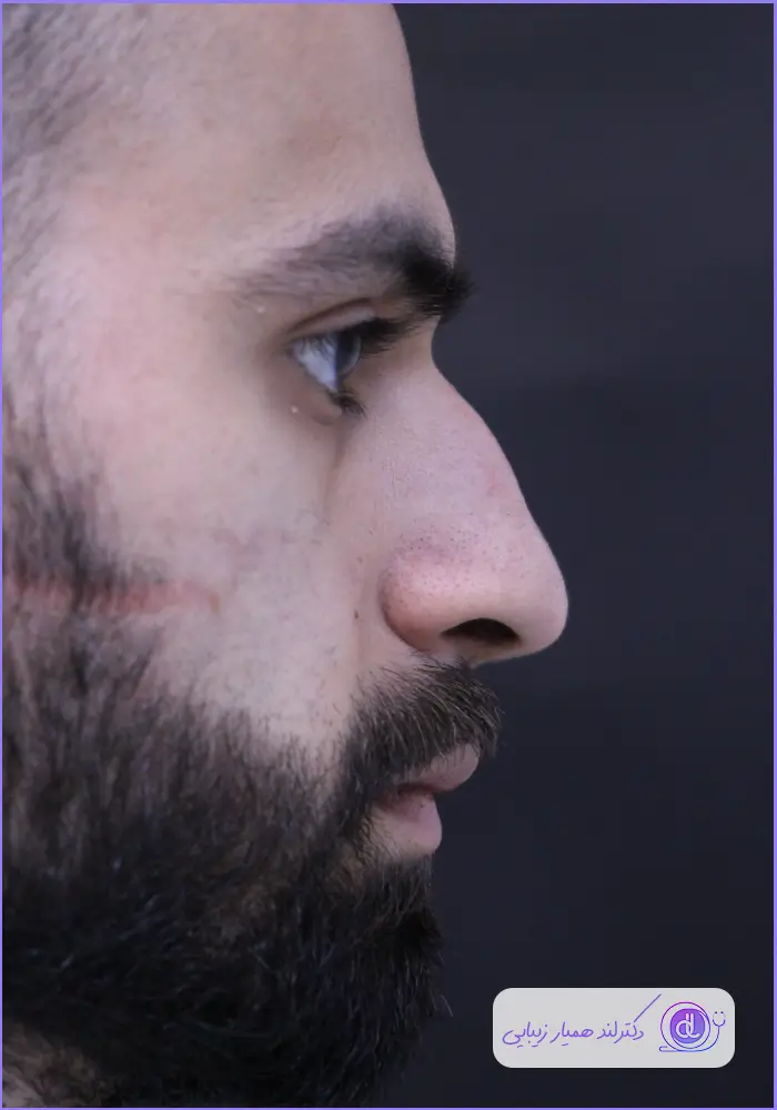 قبل و بعد عمل بینی استخوانی طبیعی مردانه در تهران