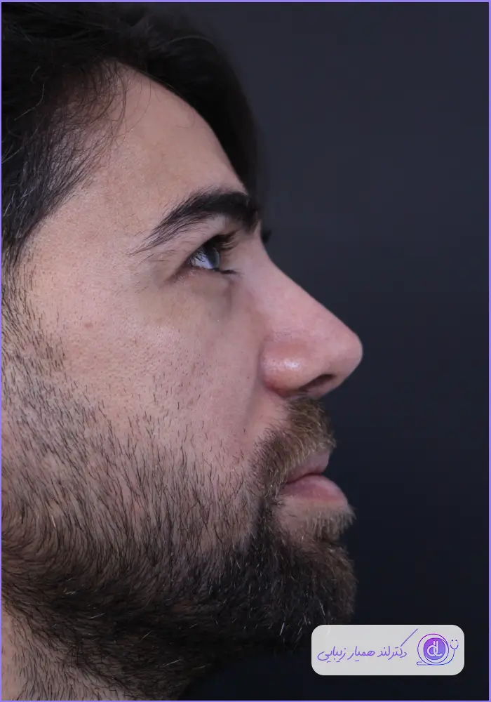 قبل و بعد جراحی بینی گوشتی خیلی بزرگ طبیعی مردانه دکتر حمید نوری