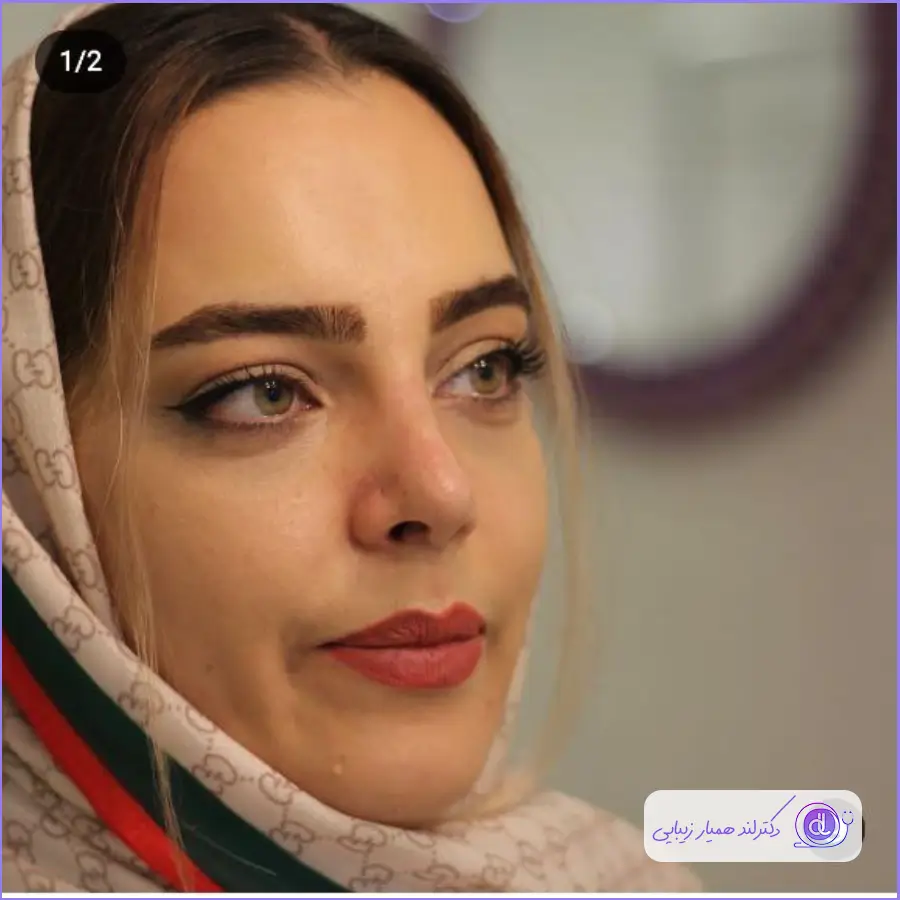 نمونه کار جراحی بینی زنانه دکتر لیلا اکبری