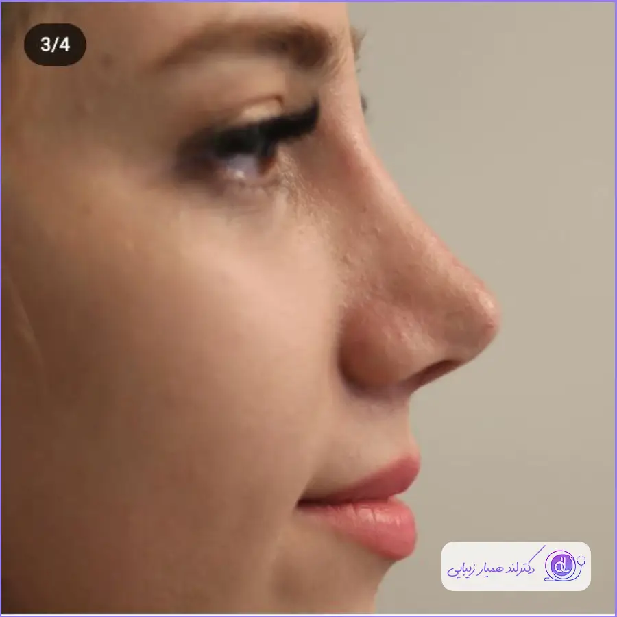 نمونه جراحی بینی طبیعی دکتر لیلا اکبری