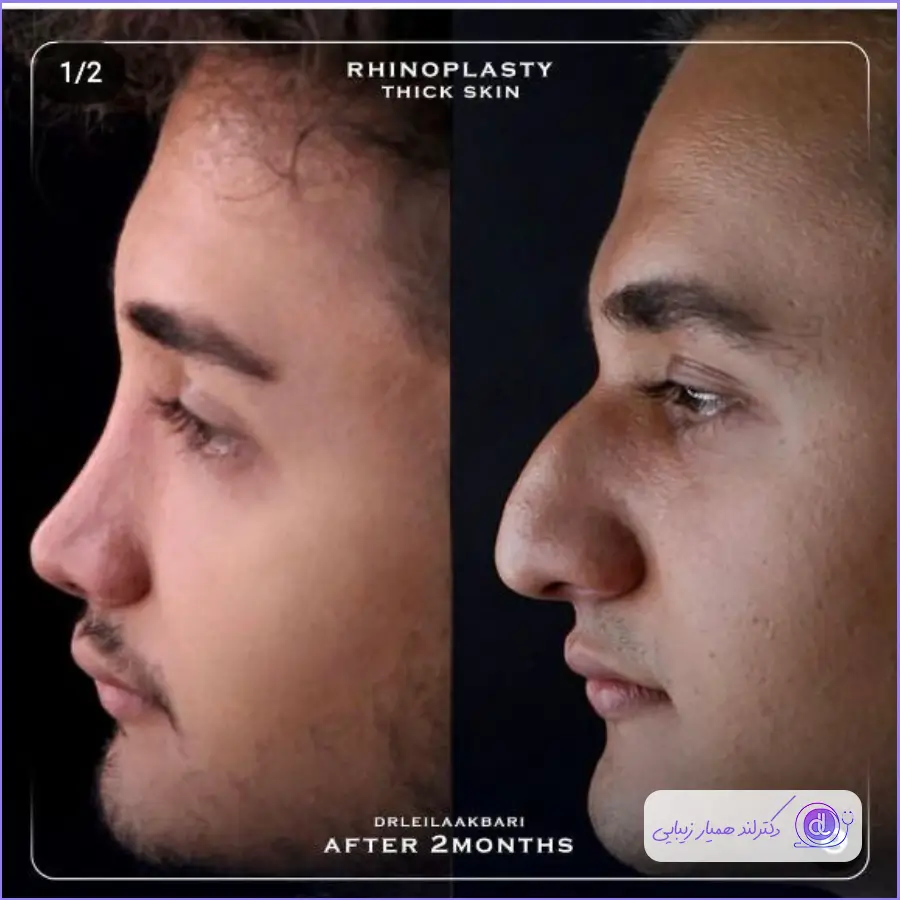 عکس قبل و بعد عمل بینی طبیعی مردانه دکتر لیلا اکبری