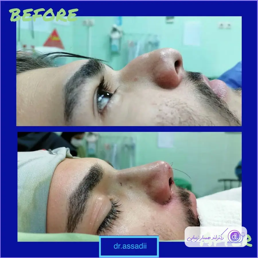 جراحی بینی گوشتی مردانه دکتر محمدعلی اسدی