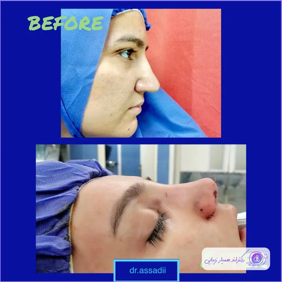 قبل و بعد عمل بینی استخوانی طبیعی دکتر محمدعلی اسدی در شیراز