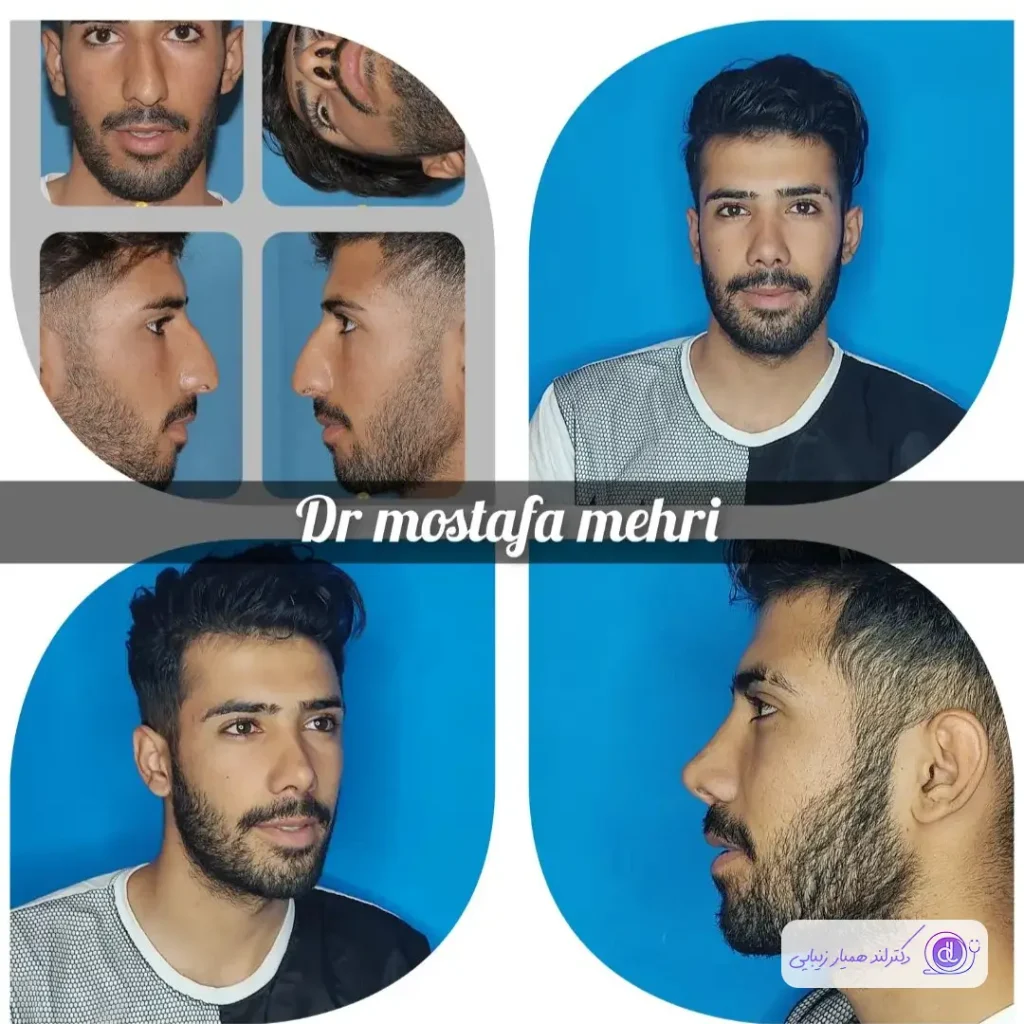 نمونه جراحی بینی مردانه دکتر مصطفی مهری