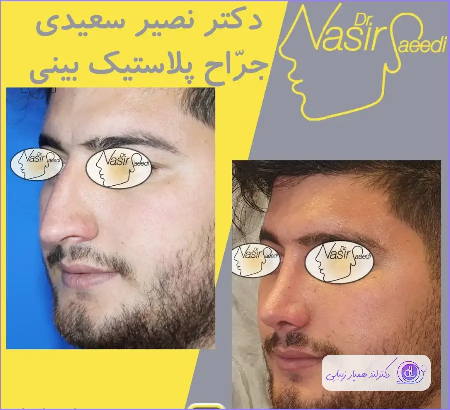قبل و بعد جراحی طبیعی بینی مردانه دکتر نصیر سعیدی