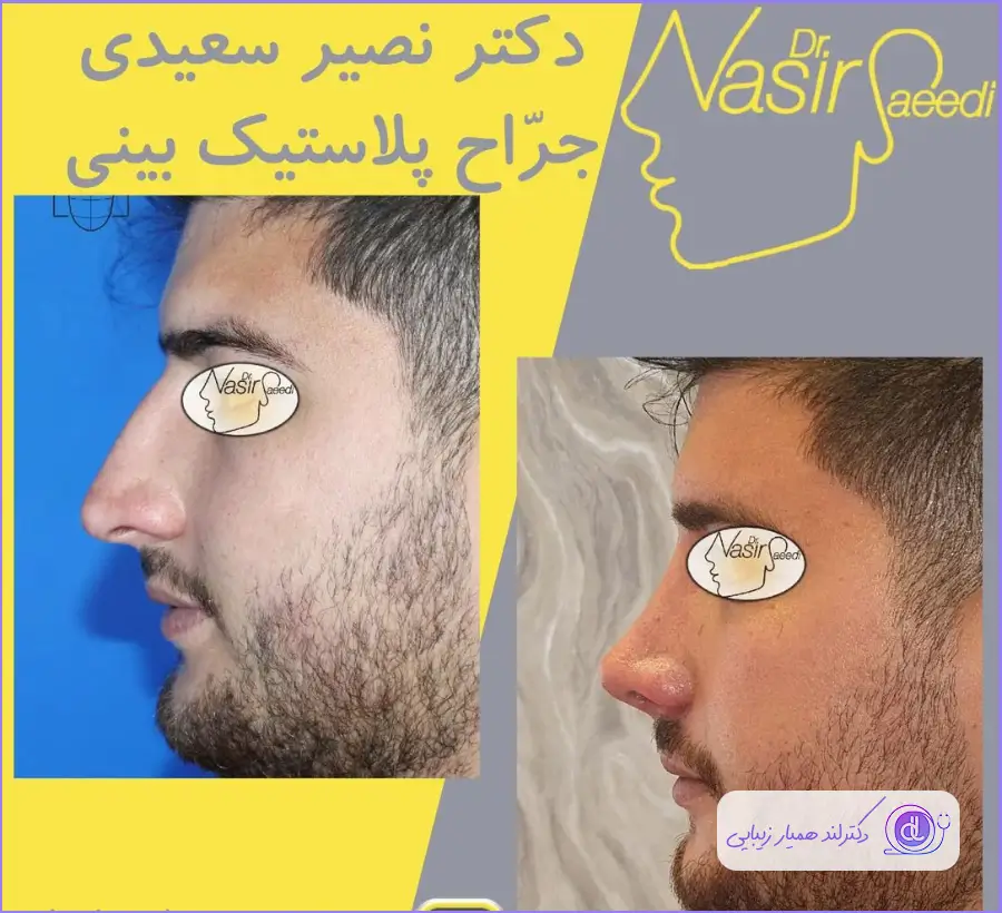 نمونه عمل بینی گوشتی مردانه دکتر نصیر سعیدی
