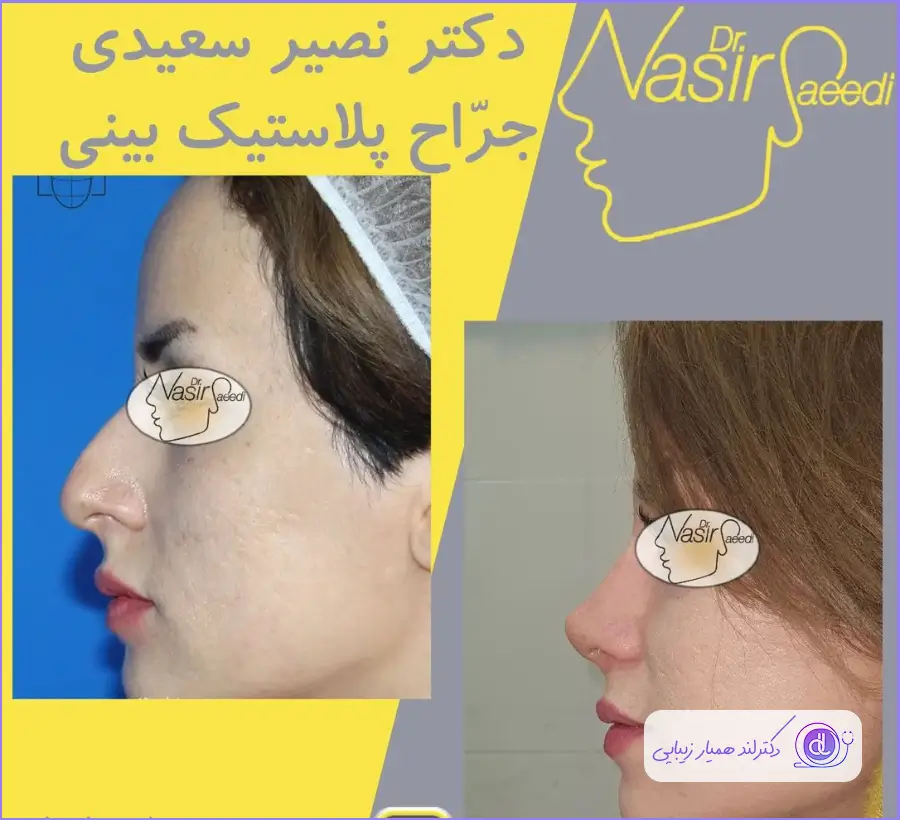نمونه کار قبل و بعد عمل زیبایی بینی دکتر نصیر سعیدی