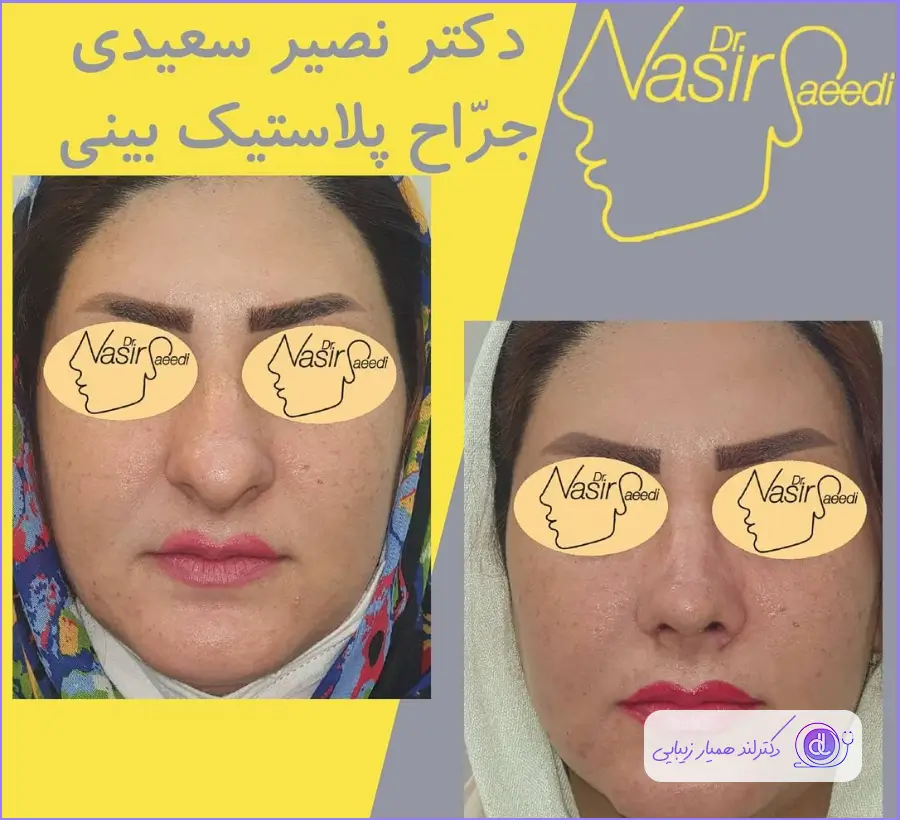 نمونه کار جراحی زیبایی بینی گوشتی دکتر نصیر سعیدی