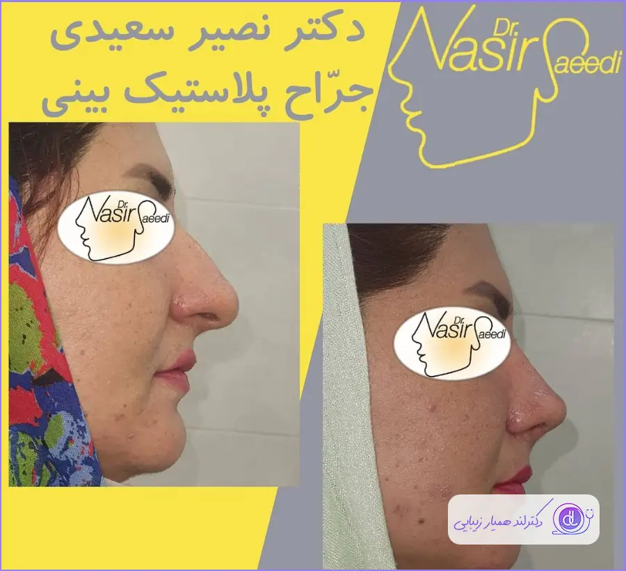عکس قبل و بعد جراحی پلاستیک بینی دکتر نصیر سعیدی