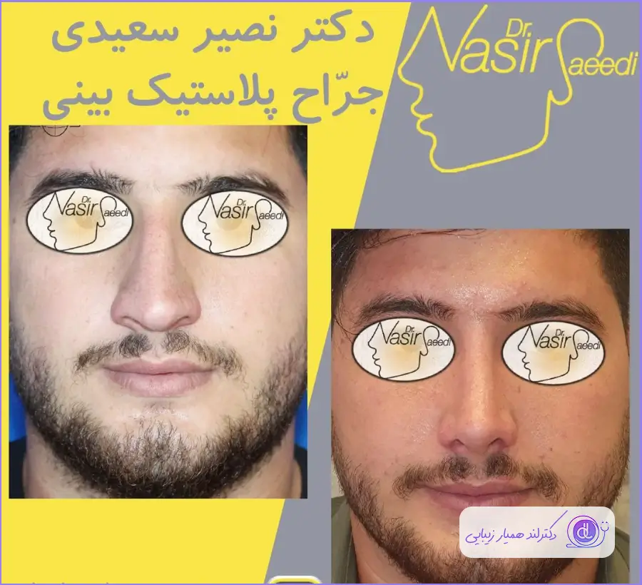 قبل و بعد جراحی بینی گوشتی مردانه دکتر نصیر سعیدی
